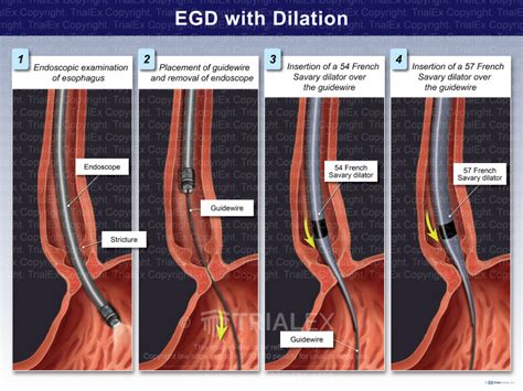 Ccs Prep Cpt Endoscopic Esophagus Procedures Physiology Anatomy And Ccs Prep Cpt Endoscopic Esophagus Procedures Physiology Anatomy And