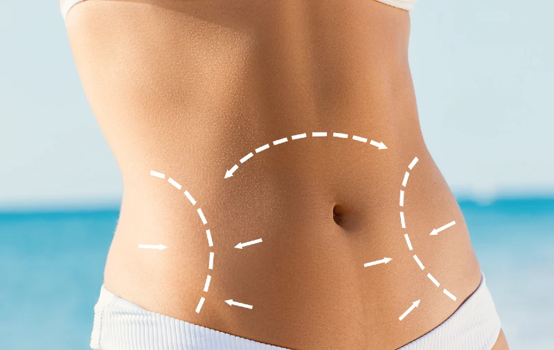 Tummy Tuck Finance Bad Credit