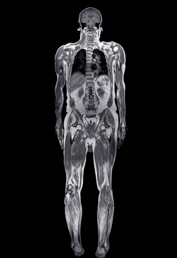 Whole Body Mri For Early Cancer Detection Medical Review Whole Body Mri For Early Cancer Detection Medical Review